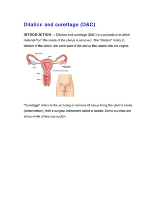 Dilation and curettage (D&C)

INTRODUCTION — Dilation and curettage (D&C) is a procedure in which
material from the inside of the uterus is removed. The "dilation" refers to
dilation of the cervix, the lower part of the uterus that opens into the vagina.




"Curettage" refers to the scraping or removal of tissue lining the uterine cavity
(endometrium) with a surgical instrument called a curette. Some curettes are
sharp while others use suction.
 