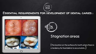 Essential requirements for development of dental caries :
3.
Stagnation areas
[The location on the surface of a tooth where there is
a tendency for food debris to accumulate. ]
 