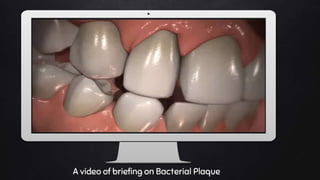 Place your screenshot here
A video of briefing on Bacterial Plaque
 