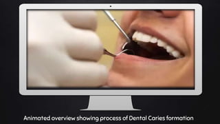 Place your screenshot here
Animated overview showing process of Dental Caries formation
 