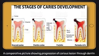 Place your screenshot here
A comparative picture showing progression of carious lesion through dentin
 