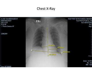 Chest X-Ray
 