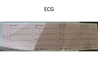ECG
 