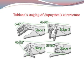 Dupuytren s Contracture By Ansarul Haq PPTX dupuytren-s-contracture-by-ansarul-haq-pptx