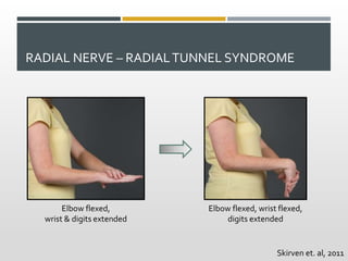 RADIAL NERVE – RADIALTUNNEL SYNDROME
Elbow flexed,
wrist & digits extended
Elbow flexed, wrist flexed,
digits extended
Skirven et. al, 2011
 