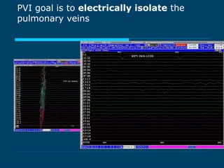 PVI goal is to electrically isolate the
pulmonary veins
 