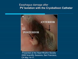 Esophagus damage afterEsophagus damage after
PV Isolation with the CryoballoonPV Isolation with the Cryoballoon Catheter
Presented at the Heart Rhythm Society
2008 Scientific Sessions, San Francisco,
CA May 14-17.
 
