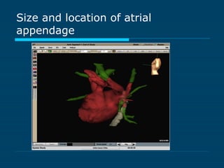 Size and location of atrial
appendage
 