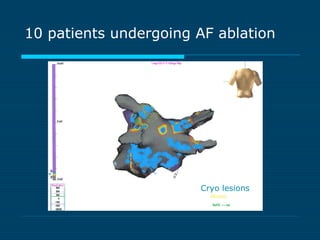 10 patients undergoing AF ablation
Cryo lesions
 