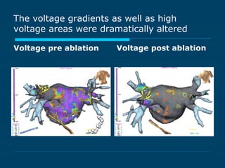 The voltage gradients as well as high
voltage areas were dramatically altered
Voltage pre ablation Voltage post ablation
 