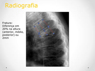 Radiografia
Fratura:
Diferença em
20% na altura
(anterior, média,
posterior) ou
2mm

 