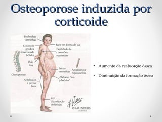 Osteoporose induzida por
corticoide

• Aumento da reabsorção óssea
• Diminuição da formação óssea

 