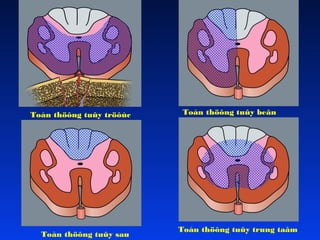 Toån thöông tuûy tröôùc

Toån thöông tuûy sau

Toån thöông tuûy beân

Toån thöông tuûy trung taâm

 