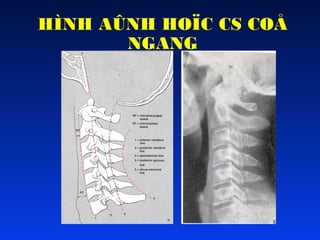 HÌNH AÛNH HOÏC CS COÅ
NGANG

 