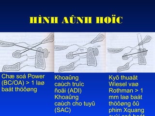 HÌNH AÛNH HOÏC

Chæ soá Power
(BC/OA) > 1 laø
baát thöôøng

Khoaûng
caùch truïc
ñoäi (ADI)
Khoaûng
caùch cho tuyû
(SAC)

Kyõ thuaät
Wiesel vaø
Rothman > 1
mm laø baát
thöôøng ôû
phim Xquang

 