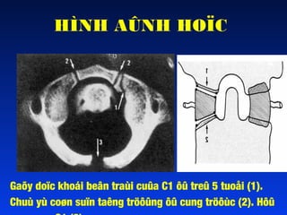 HÌNH AÛNH HOÏC

Gaõy doïc khoái beân traùi cuûa C1 ôû treû 5 tuoåi (1).
Chuù yù coøn suïn taêng tröôûng ôû cung tröôùc (2). Hôû

 