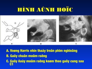 HÌNH AÛNH HOÏC

A. Voøng Harris nhìn thaáy treân phim nghieâng
B. Gaõy chaân moûm raêng
C. Gaõy ñaùy moûm raêng keøm theo gaõy cung sau
C1

 