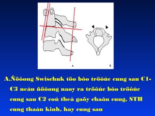 A.Ñöôøng Swischuk töø bôø tröôùc cung sau C1C3 neáu ñöôøng naøy ra tröôùc bôø tröôùc
cung sau C2 coù theå gaõy chaân cung, STH
cung thaàn kinh, hay cung sau

 