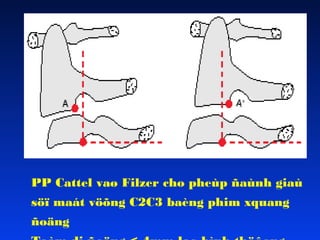 PP Cattel vaø Filzer cho pheùp ñaùnh giaù
söï maát vöõng C2C3 baèng phim xquang
ñoäng

 
