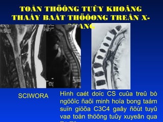 TOÅN THÖÔNG TUÛY KHOÂNG
THAÁY BAÁT THÖÔØNG TREÂN XQUANG

SCIWORA

Hình caét doïc CS cuûa treû bò
ngöôïc ñaõi minh hoïa bong taám
suïn giöõa C3C4 gaây ñöùt tuyû
vaø toån thöông tuûy xuyeân qua

 