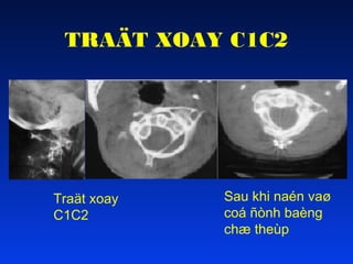 TRAÄT XOAY C1C2

Traät xoay
C1C2

Sau khi naén vaø
coá ñònh baèng
chæ theùp

 