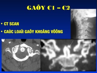 GAÕY C1 – C2
• CT SCAN
• CAÙC LOAÏI GAÕY KHOÂNG VÖÕNG

 
