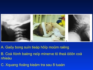 A. Gaõy bong suïn tieáp hôïp moûm raêng
B. Coá ñònh baèng neïp minerve tö theá öôõn coå
nhieàu
C. Xquang ñoäng kieåm tra sau 8 tuaàn

 