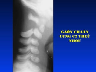 GAÕY CHAÂN
CUNG C2 TREÛ
NHOÛ

 