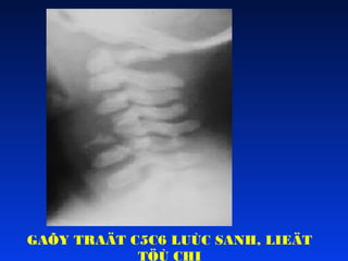 GAÕY TRAÄT C5C6 LUÙC SANH, LIEÄT
TÖÙ CHI

 