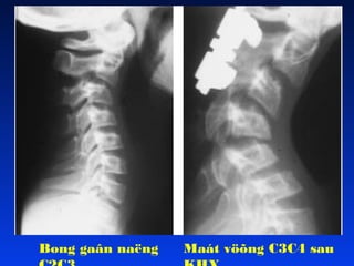 Bong gaân naëng

Maát vöõng C3C4 sau

 