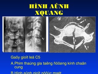 HÌNH AÛNH
XQUANG

Gaõy gioït leä C5
A.Phim thaúng gia taêng ñöôøng kính chaân
cung

 