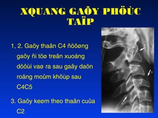 XQUANG GAÕY PHÖÙC
TAÏP
1, 2. Gaõy thaân C4 ñöôøng
gaõy ñi töø treân xuoáng
döôùi vaø ra sau gaây daõn
roäng moûm khôùp sau
C4C5
3. Gaõy keøm theo thaân cuûa
C2

 