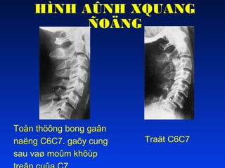 HÌNH AÛNH XQUANG
ÑOÄNG

Toån thöông bong gaân
naëng C6C7. gaõy cung
sau vaø moûm khôùp

Traät C6C7

 