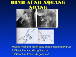 HÌNH AÛNH XQUANG
ÑOÄNG

Xquang ñoäng: di leäch gaõy chaân moûm raêng C2
A. Di leäch ra sau khi ngöûa coå
B. Di leäch ra tröôùc khi gaäp coå

 