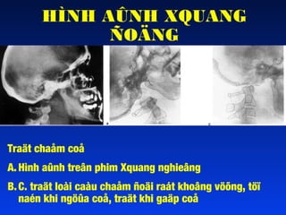 HÌNH AÛNH XQUANG
ÑOÄNG

Traät chaåm coå
A. Hình aûnh treân phim Xquang nghieâng
B. C. traät loài caàu chaåm ñoäi raát khoâng vöõng, töï
naén khi ngöûa coå, traät khi gaäp coå

 