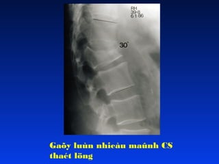 Gaõy luùn nhieàu maûnh CS
thaét löng

 