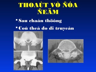 THOAÙT VÒ ÑÓA
ÑEÄM
 Sau chaán thöông
 Coù theå do di truyeàn

 