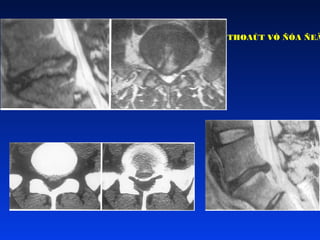 THOAÙT VÒ ÑÓA ÑEÄ

 