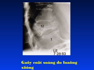 Gaõy coät soáng do loaõng
xöông

 