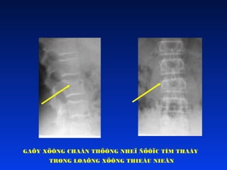 GAÕY XÖÔNG CHAÁN THÖÔNG NHEÏ ÑÖÔÏC TÌM THAÁY
TRONG LOAÕNG XÖÔNG THIEÁU NIEÂN

 