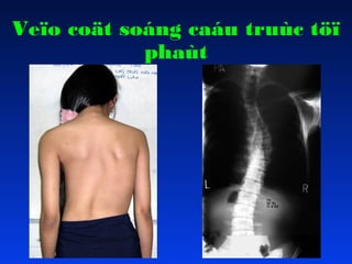 Veïo coät soáng caáu truùc töï
phaùt

 