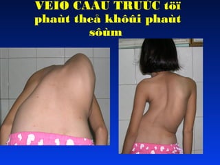 VEÏO CAÁU TRUÙC töï
phaùt theå khôûi phaùt
sôùm

 