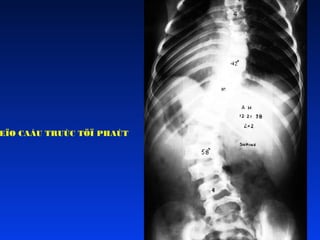 EÏO CAÁU TRUÙC TÖÏ PHAÙT

 