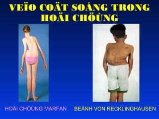 VEÏO COÄT SOÁNG TRONG
HOÄI CHÖÙNG

HOÄI CHÖÙNG MARFAN

BEÄNH VON RECKLINGHAUSEN

 