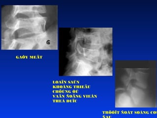 GAÕY MEÄT

LOAÏN SAÛN
KHOÂNG TRIEÄU
CHÖÙNG ÔÛ
VAÄN ÑOÄNG VIEÂN
THEÅ DUÏC

TRÖÔÏT ÑOÁT SOÁNG COÙ

 