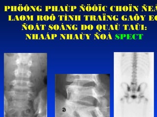 PHÖÔNG PHAÙP ÑÖÔÏC CHOÏN ÑEÅ
LAØM ROÕ TÌNH TRAÏNG GAÕY EO
ÑOÁT SOÁNG DO QUAÙ TAÛI:
NHAÁP NHAÙY ÑOÀ SPECT

 