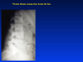 Vieâm thaân soáng ñóa ñeâm do lao

 