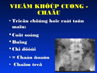VIEÂM KHÔÙP CUØNG CHAÄU
• Trieäu chöùng hoïc raát taûn
maïn:
 Coät soáng
 Buïng
 Chi döôùi
• = Chaån ñoaùn
• Chaäm treã

 