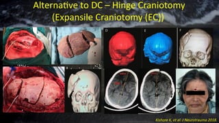 Alternative to DC – Hinge Craniotomy
(Expansile Craniotomy (EC))
Kishore K, et al. J Neurotrauma 2018.
 