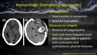 Hemorrhage (hematoma expansion)
Causes
• Loss of tamponade effect
compounding the natural
tendency of contusions to
progress
Consequences
• Deterioration in sensorium
• Need for evacuation
Measures to mitigate
• Reversal of coagulopathy
• Early and more frequent scans
after DC especially in patients
with contusions and
contralateral calvarial fractures
Gopalakrishnan MS, et al. Front Neurol 2018.
 